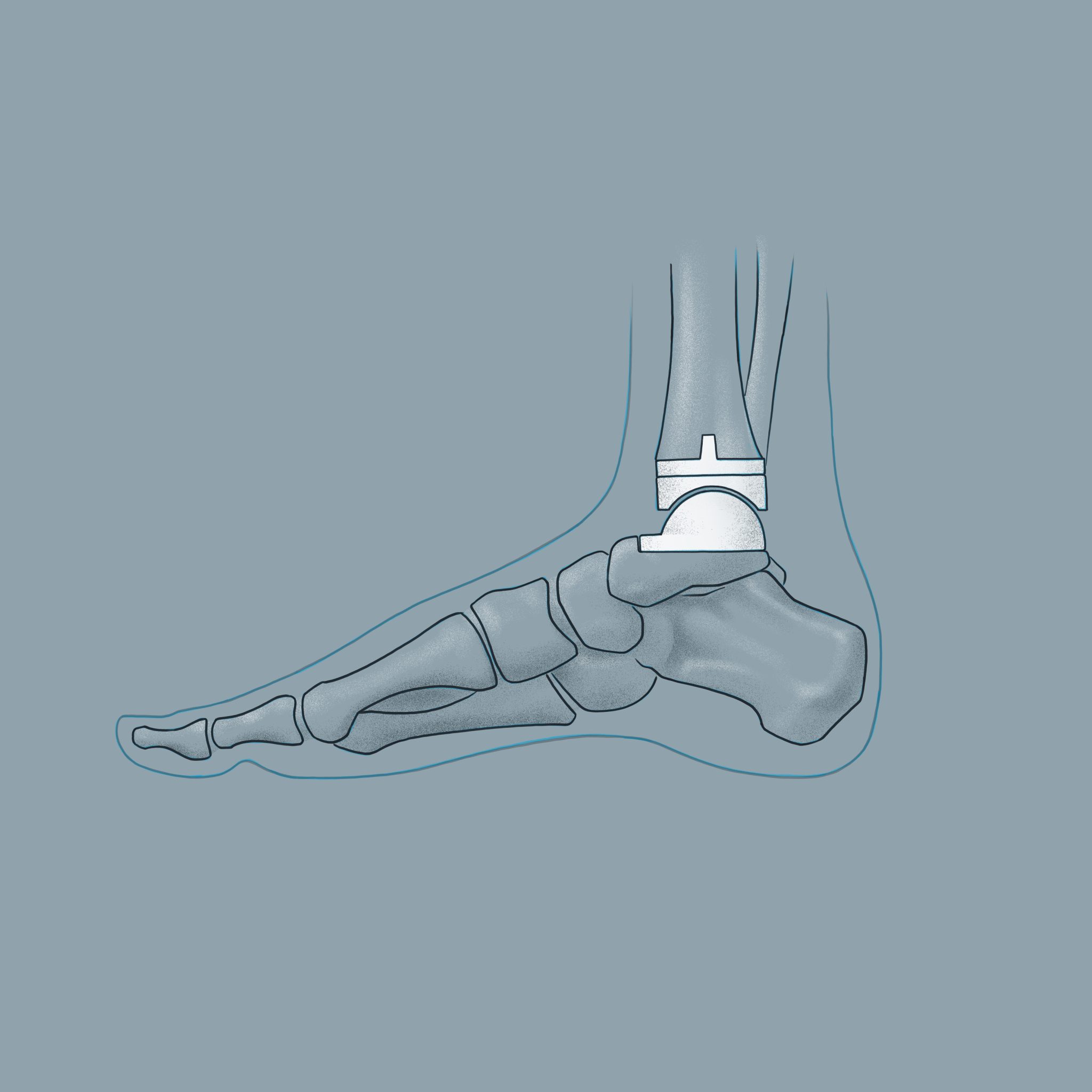 Sprunggelenk Arthrose - Orthopäde 1080 Wien | Dr. Martin Gruber